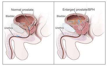 intervento prostata con laser al tullio