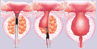 Prosztata adenoma spermogramma Adenoma alla prostata intervento