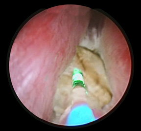 operazione prostata laser